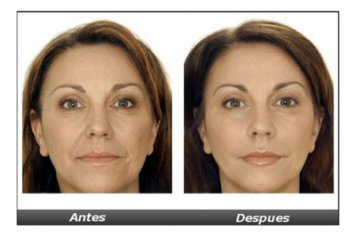 Face Cavitation Before And After